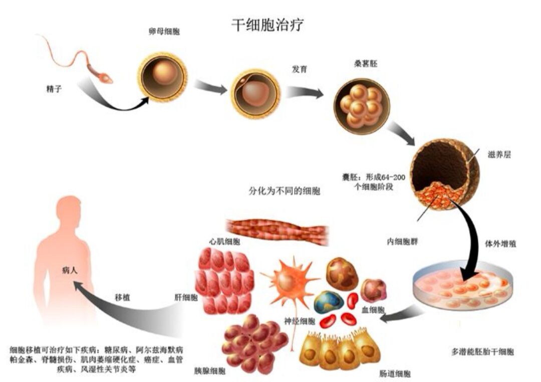 干细胞治疗糖尿病最新进展综述