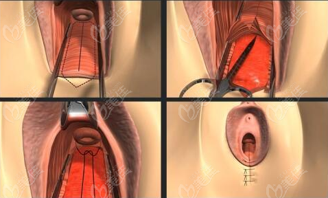 最新缩阴手术，女性盆底健康的关注焦点探讨